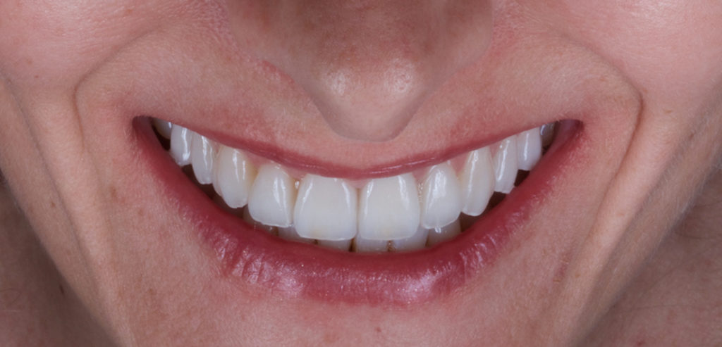 Blanqueamiento dental después