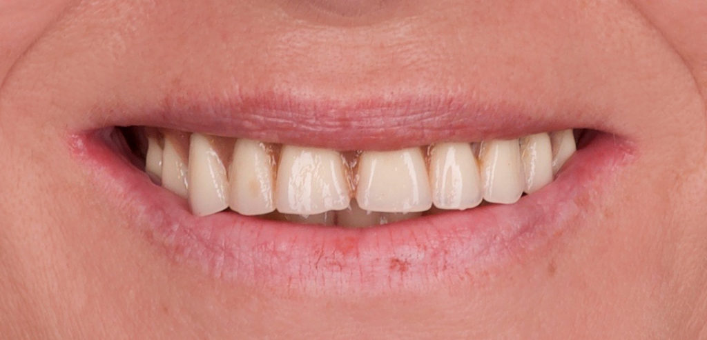Implantes y prótesis antes