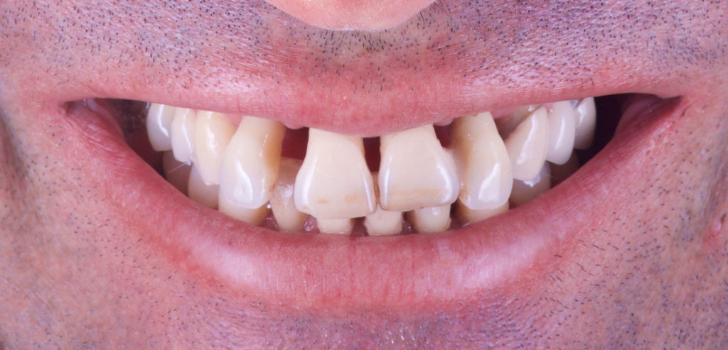 Implantes y prótesis antes 3