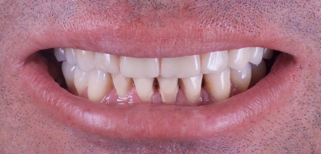 Implantes y prótesis después 3