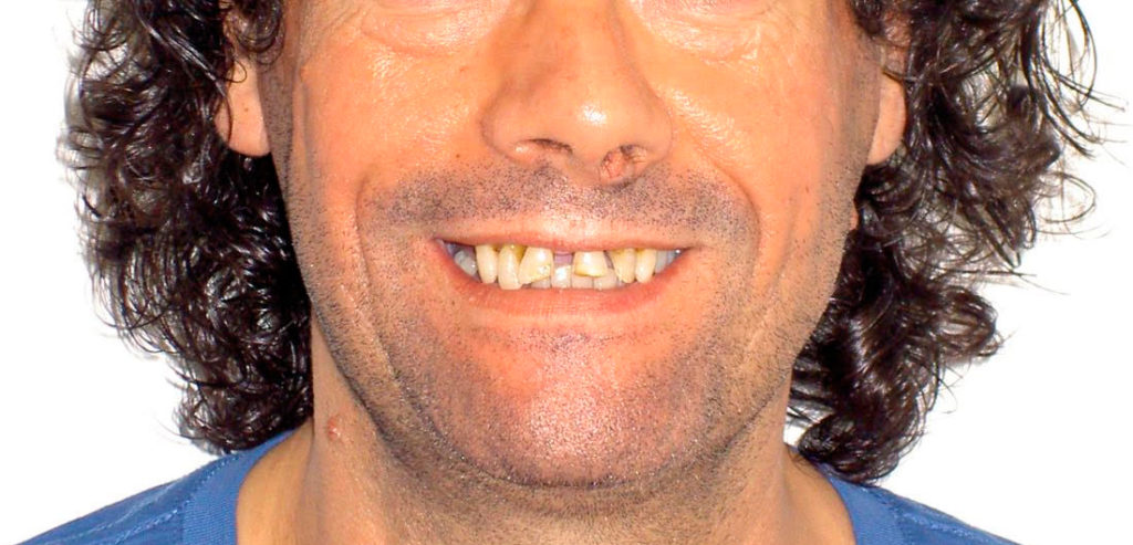 Ortodoncia convencional antes