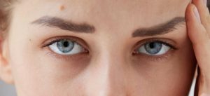 ojeras Transitorias