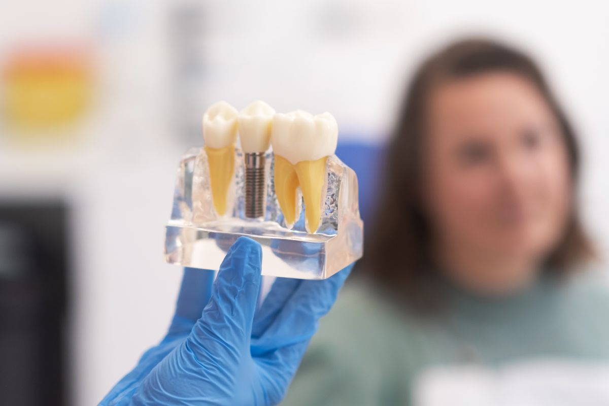 Todo sobre los implantes dentales post extraccion