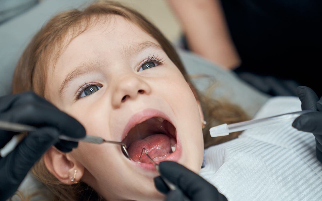 Sellar muelas en niños para prevenir caries y proteger la superficie masticatoria. Clínica Durán & Burgos
